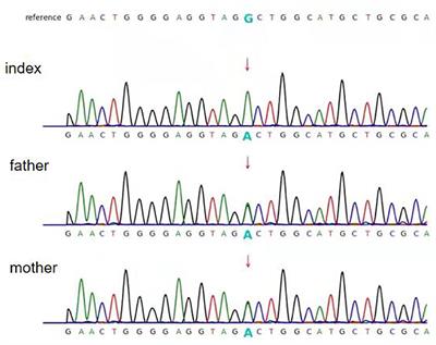 PC Splice-Site Variant c.1825+5G>A Caused Intron Retention in a Patient With Pyruvate Carboxylase Deficiency: A Case Report